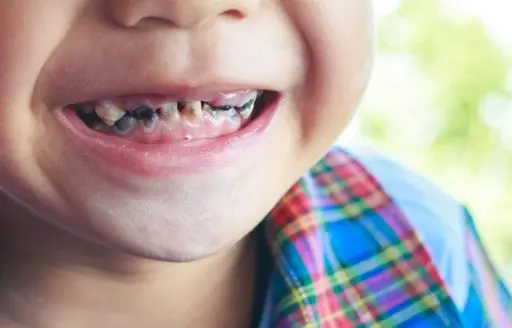 cara menghilangkan gigi hitam secara alami