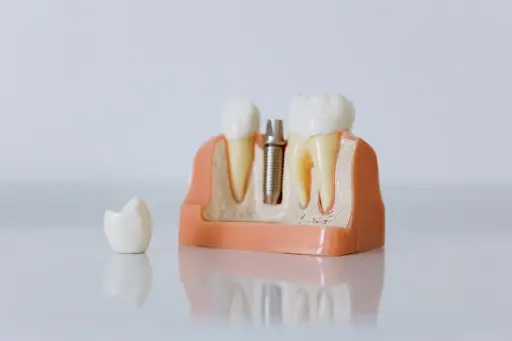 perbedaan implan gigi dan gigi palsu
